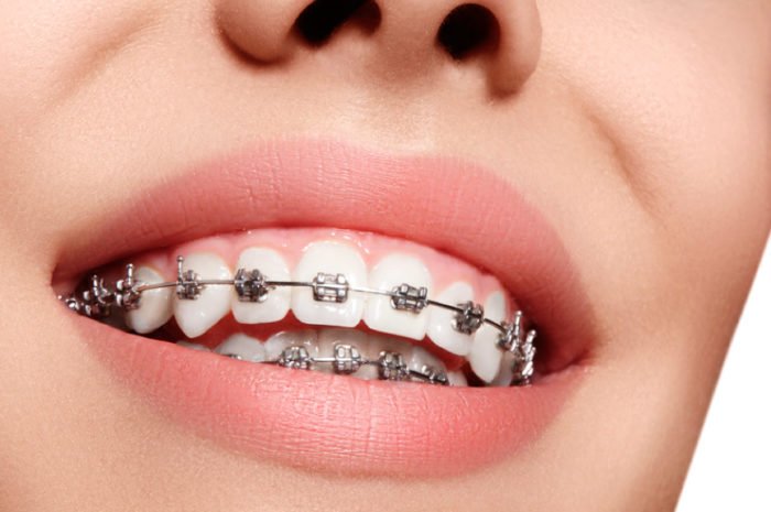 ortodoncia brackets metalicos dental roca2 700x465